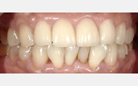 前歯部不正咬合による発音障害。象牙質に及ぶカリエス(虫歯)