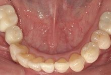 多数歯欠損による咬合機能障害