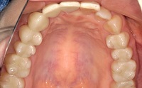 全顎的に補綴物の不適多数。多数歯に２次カリエス(虫歯)。咬合も不正