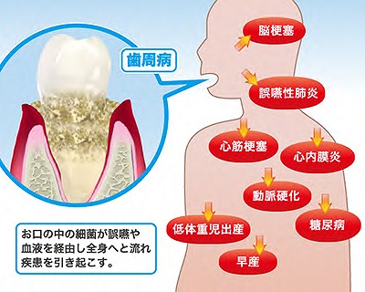 歯周病と全身疾患の関係性