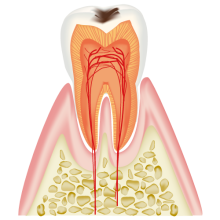 C1：エナメル質にごく小さな穴が開いたむし歯