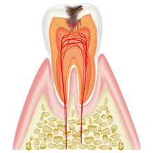 C2：象牙質に達したむし歯