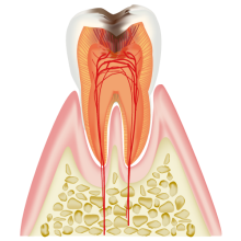 C3：神経に達したむし歯