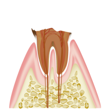 C4:歯の根だけが残ったむし歯